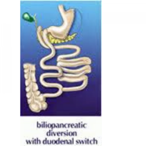 Biliopancreatic diversion w DS