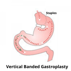 Vertical Banded Gastroplasty